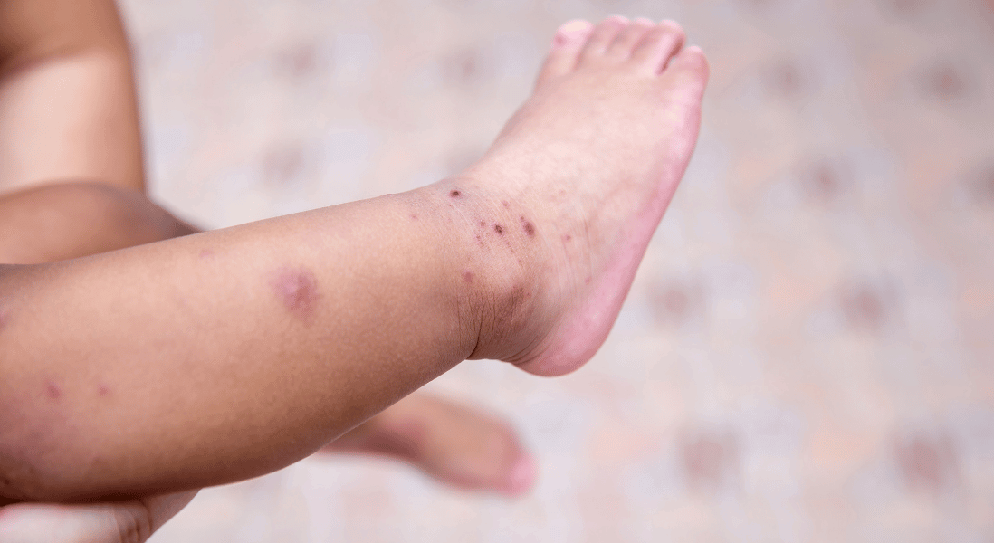 fmd quarantine enforcement for toddlers