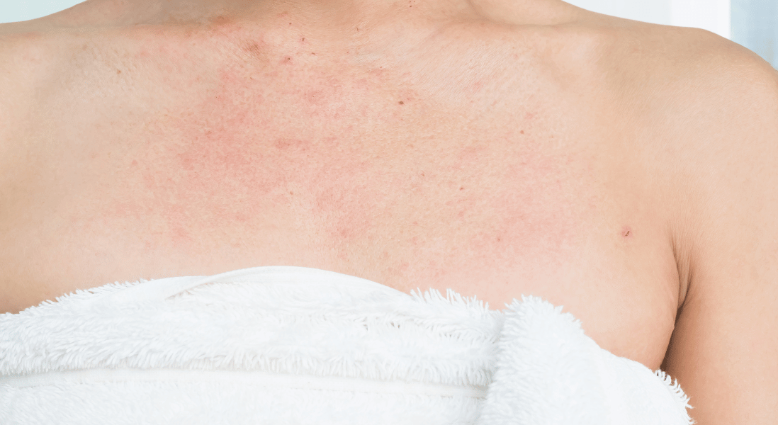 chest skin identifying allergy from bedbugs in cape flats 